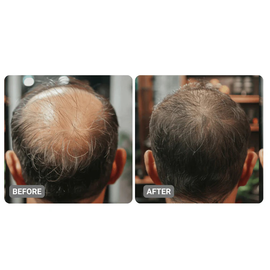 Root Activator Suero para hombres Pérdida del cabello: aumento del crecimiento del cabello con solo 4 usos por semana*