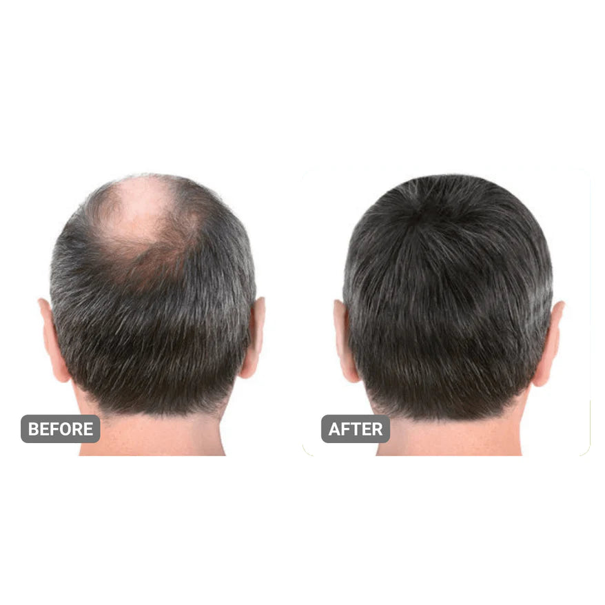 Root Activator Suero para hombres Pérdida del cabello: aumento del crecimiento del cabello con solo 4 usos por semana*