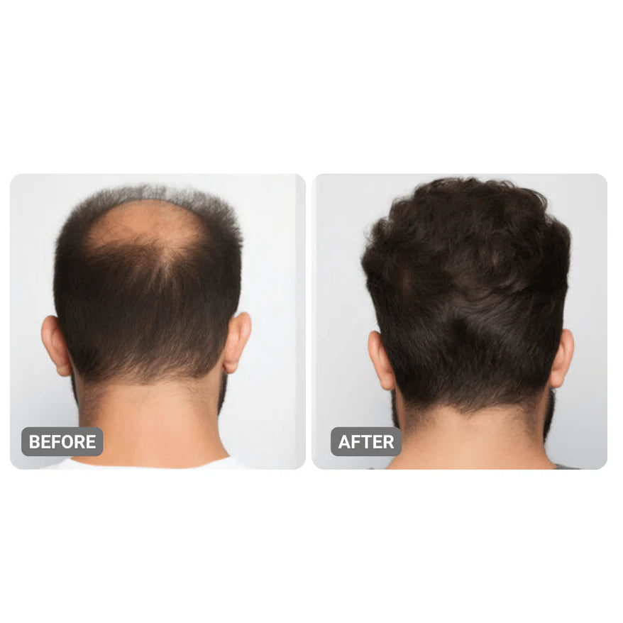 Root Activator Suero para hombres Pérdida del cabello: aumento del crecimiento del cabello con solo 4 usos por semana*